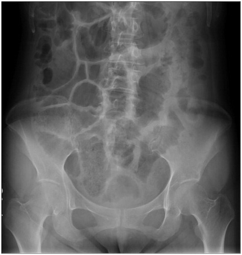 Figure 3. Abdominal X-ray image of an SSc patient with SIBO. The storage of gas in the intestinal tract is observed throughout the abdomen. SSc: systemic sclerosis; SIBO: small intestinal bacterial overgrowth.