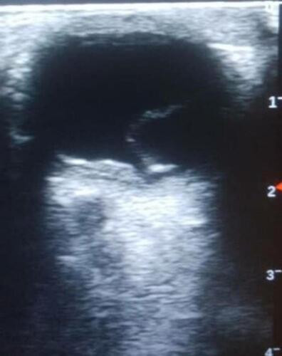 Figure 4 B-mode ocular ultrasound of the left eye showing retinal detachment.