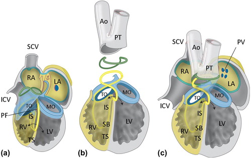 Figure 3. Ventricular septation. a: Schematic overview of ventricular septation. Remodeling of the primary fold (PF) is essential for the formation of the right ventricular (RV) inlet compartment and positioning of the right side of the AV canal (AVC) above the RV, which will result in formation of the tricuspid oriﬁce (TO). The mitral oriﬁce (MO) will remain above the left ventricle (LV). Formation of the TO and MO is achieved by fusion of the atrioventricular endocardial cushions (indicated in pale blue). The anterior trabeculated part of the ventricular septum (TS) derives from infolding of the anterior part of the primitive ventricle, whereas the inlet septum (IS) and inlet cavity of the RV are formed by expansion of the posterior part of the PF. The borderline between the RV inlet compartment and folding septum is visible as the septal band (SB). b and c: In the outflow tract (OFT), the endocardial cushions (indicated in pale blue) fuse to separate the left and right ventricular OFT in an aorta (Ao) and pulmonary trunk (PT). During normal septation, neural crest cells migrate into the cushions and orchestrate the formation of an OFT septum before they go into apoptosis (not shown). At the ventricular level, the primary interventricular foramen (double arrow) is still patent but will be closed with completion of OFT septation and connection of the Ao to the LV. (ICV = inferior caval vein; LA = left atrium; LV = left ventricle; MO = mitral orifice; SCV = superior caval vein; RA = right atrium; TO = tricuspid orifice). Modified after: Crawford Cardiology (Citation117).