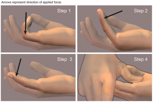 Figure 2. Hurst’s four-step finger extension procedure after CCH injection of a central cord contracting both the MP and PIP joints of the little finger. The hand is placed on the examination table with the wrist oriented for palmar flexion with the forearm facing upward. Step 1: the MP joint is extended with the PIP joint flexed. Step 2: the PIP joint is extended with the MP joint flexed. Step 3: both the MP and PIP joints are extended. Step 4: with the finger extended, pressure is applied to the residual cord. Photos courtesy of LC Hurst.