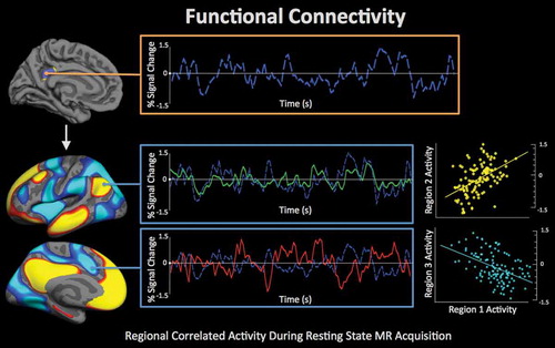 Figure 6. Functional connectivity refers to procedures used to examine covariance in regional brain activity. Correlated activity across brain regions is interpreted to indicate shared demands for a cognitive operation between regions, and potentially direct communication between regions. The image demonstrates a ‘seed’ region in the posterior cingulate (top) in which the fMRI signal (based on the blood oxygenation level-dependent mechanism of contrast) is quantified across time (blue waveform) and correlated with other regions throughout the brain. This analysis highlights functional connectivity among a set of regions referred to as the ‘default mode network,’ which has been demonstrated to be compromised across a range of conditions including blast exposure [Citation73]. The red-yellow regions demonstrate positive correlation to the seed in which the fMRI signal is quantified across time (green waveform) and plotted over the fMRI signal from the seed (middle). The positive correlation between these two time-series is plotted in yellow (middle right). The blue-light blue regions demonstrate anticorrelation to the seed in which the fMRI signal is quantified across time (red waveform) and plotted over the fMRI signal from the seed. The anticorrelation between these two time-series is plotted in light blue (bottom right).