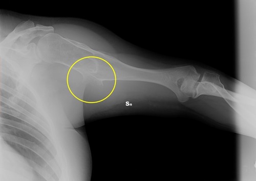 Figure 9 Clinical case 2. Pre-operative radiograph. In the yellow circle, the exostosis that had to be removed.