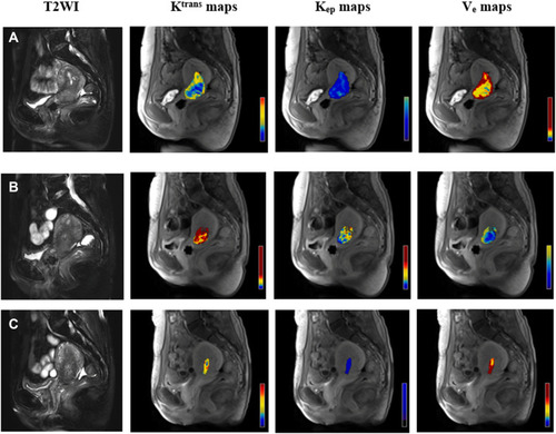 Figure 4 Dynamic changes of DCE-MRI parameters in a non-responder. Images in each row are representative images from three different timepoints (A=pre-RT; B=mid-RT; C=post-RT) from a 46-year old patient with IIB disease. The images of the primary tumor from T2WI are presented to show volume changes in mid- and post-RT in comparison with the baseline. Corresponding kinetic parameters (Ktrans, Kep, and Ve maps) of the primary tumor are presented to show permeability changes from the three given timepoints (Pre-, mid-, and post-RT). Ktrans in pre-, mid-, and post-RT were 0.097 min−1, 1.601 min−1, and 0.306 min−1, respectively; Kep in pre-, mid-, and post-RT were 0.422 min−1, 4.958 min−1, and 0.544 min−1, respectively; Ve in pre-, mid-, and post-RT were 0.263, 0.335, and 0.565, respectively. This patient achieved a partial response after the treatment.