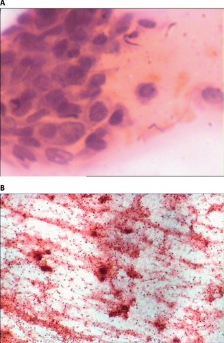 Figure 4 Histological specimen of jugulodigastric lymph nodeNotes: (A) Biopsy from the ulcerated jugulodigastric node showing spindle cell carcinoma. (B) Cytology smear from the ulcerated jugulodigastric node showing spindle cell carcinoma.