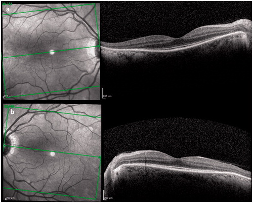 FIGURE 2. (a) Right and (b) left eye: SD-OCT images showing choroidal fold resolution 14 days after the therapy.