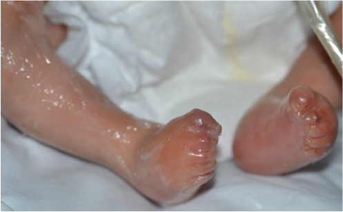 Figure 4 A collodion membrane encases this infant’s body, including his feet and toes.