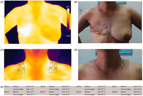 Figure 1. Acquirement of the lateral-view side mirrors and measurement of the changes in the difference of skin temperature (DST). (A and B) The range of imaging. (C–E) The calculation of the DST. DSTaverage/max=the average/maximum temperature (treated) the average/maximum temperature (control).