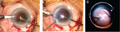 Figure 1 Transcorneal vitrectomy.