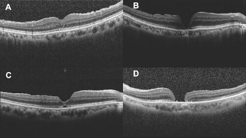 Figure 2 Classification of macular hole closure based on OCT images: (A) U-type, (B) V-type, (C) irregular or W-type, (D) open-type or unclosed hole.