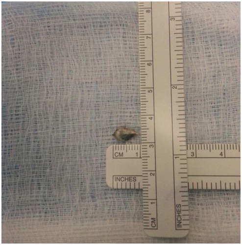 Figure 3. The retrieved metallic foreign body measured 10 mm ×5 mm.