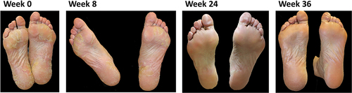 Figure 4. Changes in psoriasis skin lesions during treatment with secukinumab: case 3.