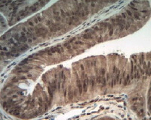 Figure 4 Positive expression of Piwil2 in colonic adenoma, ×400.