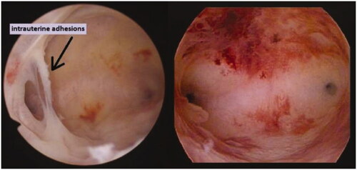 Figure 2. Follow-up hysteroscopy in patients after myomectomy with periprocedural uterine cavity breach with presence of intrauterine synechia on the left and with physiological intrauterine finding on the right.