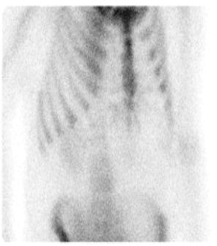 Figure 1. Nuclear Medicine Imaging revealing enhanced activity at the sternum suspicious of inflammation