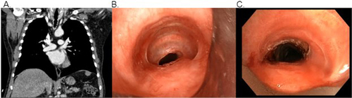 Figure 6 Grade 3, concentric stenosis seen on CT chest (A) and pre-dilation bronchoscopy (B). Post dilation bronchoscopy reveals airway patency (C).