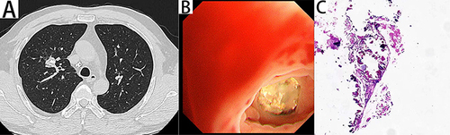 Figure 2 Chest computed tomography (CT), bronchoscopic changes, and pathological findings in February 2022.