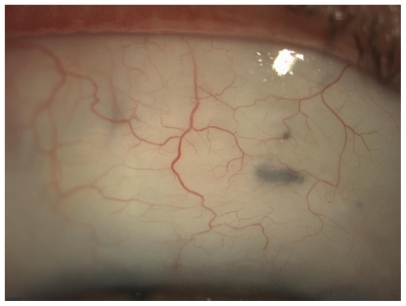 Figure 5 Appearance of bleb without cysts (E2-V3-H2).