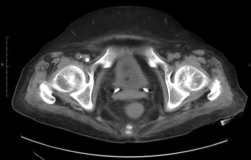 Figure 4 The coronal non-contrast-enhanced computed tomography (CT) scan (The bladder level) revealed complete regression of the imaging findings of the disease. CT scans were taken on the 27th day of hospitalization.