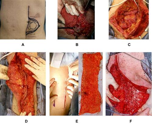 Figure 4 We performed a midline incision similar to the previous scar and we cut a spindle shape around the mass at 2cm margin from the mass (A). There was no exposure of the tumor to abdominal side. We used ultrasonically activated scalpel when we cut the muscle (B). Next, we removed the rectus abdominis muscle from the left lateral end. The abdominal wall defect was 10cm×10cm (C). The hernia was repaired with a simple closure using anterior layer of rectus sheath and the defect was closed by suturing the right anterior layer of rectus sheath to the left aponeurosis of external oblique muscle (D). We used a fascia lata patch measuring 15 cm × 5 cm (E) to repair the defect in the left abdomen (F).