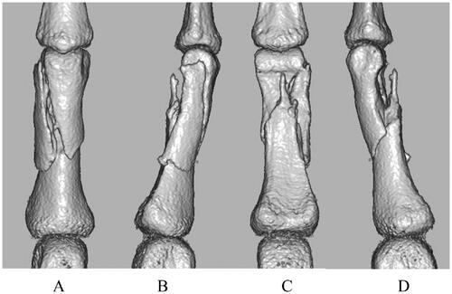 Figure 3. Preoperative three-dimensional computed tomography: (A) dorsal side, (B) radial side, (C) volar side, and (D) ulnar side.