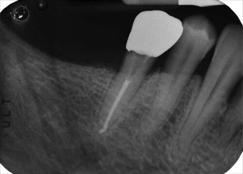 Figure 14 Two years control periapical radiography of the functional and clinically successful treated tooth.