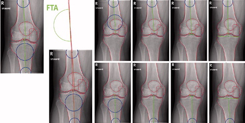 Figure 2. Measurement of the femoro-tibial angle (FTA) on standard knee radiographs.Tib4Fem4Tib3Fem3Tib2Fem2Tib1Fem1