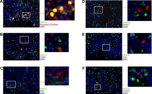 Figure 5 Distribution of MMP-9 in infiltrating cells of NIP tissue. (A–F) immunofluorescence co-staining for MMP-9 (green) with neutrophil elastase, CD68, ECP, MAST, CD4, or FOXP3 (red) were performed to detect which cell type secrete MMP-9. Each co-staining was presented with ×400 magnification (scale bar = 20μm). Higher magnification photographs were presented on the right side of the images.