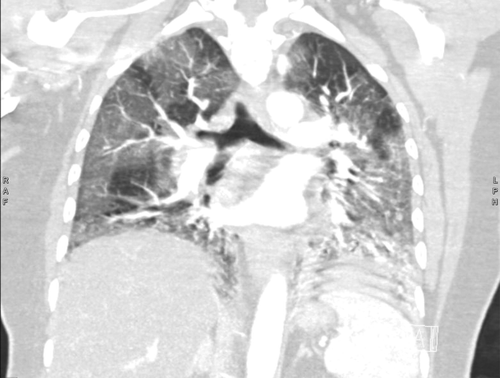 Figure 1. Initial CT scan of the chest (coronal slice, lung window) showing extensive patchy ground-glass opacities