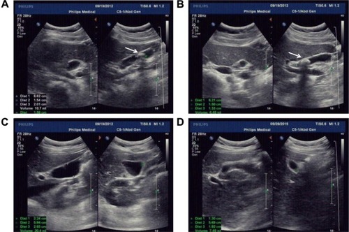 Figure 2 A significant alleviation of GBEF before and after surgery.Notes: (A, B) Preoperational ultrasound results. Preoperational ultrasound found a single stone with a diameter of 15.6 mm. The white arrow shows the single stone. Preoperational GBEF was 39%. (C, D) Postoperational ultrasound results. Postoperational ultrasound found no stone residual. Postoperational GBEF was 63%.Abbreviation: GBEF, gallbladder ejection fraction.