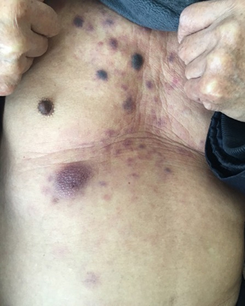 Figure 2 Multiple purple nodules on his chest.