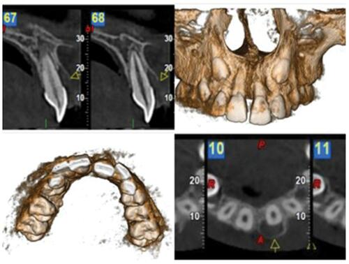 Figure 3 CBCT images showing the bone destruction and cortical plate expansion in relation to labial aspect of 21.