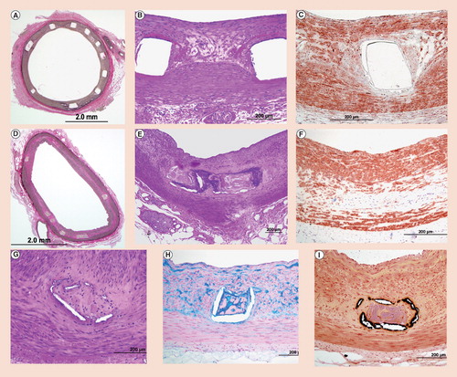 Figure 2. Representive histological sections of Bioabsorbable Vascular Solutions stent in pig coronary arteries removed at (A) 1 month and (D) 36 months (EVG staining).(B & E) High-power images of strut regions (H & E) showing presence of fibrin at 1 month and absence at 36 months. Note the strut outline is barely visible at 36 months. α actin-positive smooth muscle cells are observed in the neointima and media at (C) 1 month and (F) 36 months. (G) Complete degradation of the polymer strut with surrounding basophilic deposition of calcium (H & E). (H) Alcian blue positive proteoglycan infiltrated the matrix of the Bioabsorbable Vascular Solutions stent stent strut. (I) Calcification is seen around the degraded stent strut (von Kossa).Modified and reproduced with permission from Citation[18].