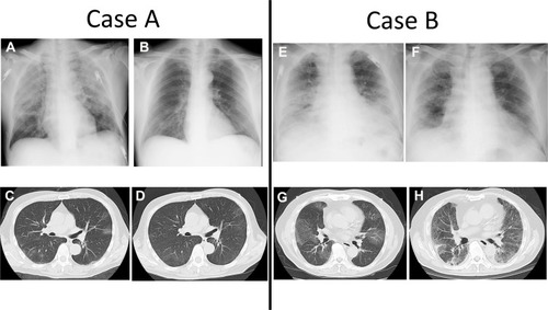 Figure 2 Serial chest X-ray and CT scans of cases (A and B). (A) CXR on day 7 (ICU day 0) shows worsening bilateral opacities. (B) CXR on day 88 shows normal lung parenchyma. (C) Chest CT scan on day 0 shows bilateral light GGOs. (D) Chest CT on day 95 shows disappearing bilateral GGOs, without the evidence of lung fibrosis. (E) CXR on day 3 (ICU day 0) shows the worsening of bilateral opacities. (F) CXR on day 13 shows improvement in aeration. (G) Chest CT scan on admission (day 0) shows light bilateral GGOs. (H) Chest CT scan on day 23 shows bilateral GGOs.