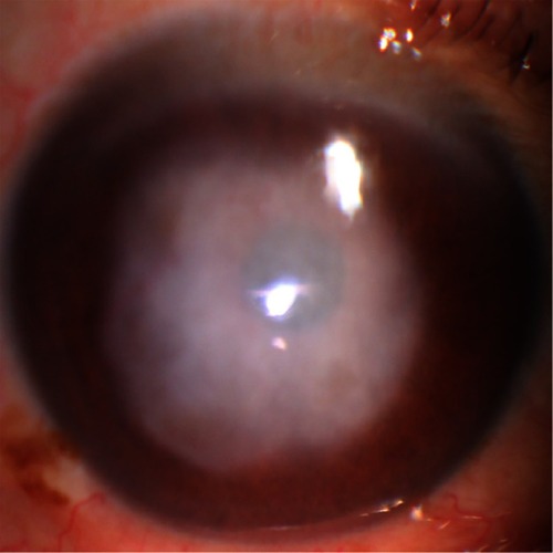 Figure 1 An example of corneal ulcer shown in slit lamp.