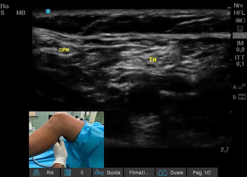 Figure 2 Ultrasound popliteal sciatic nerve block (UPSNB): patient and transducer positioning.