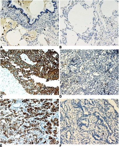 Figure 1 Immunohistochemical staining of KRT17 in non-small cell lung cancers and normal lung tissues. (A and B), KRT17 expression was negative in matured normal bronchial epithelial cells (A) and alveolar pneumocytes (B), but positive in partial basal cells under the normal bronchial epithelial cells (200×). (C) High expression of KRT17 in a representative lung squamous cell carcinoma case (200×). (D) Negative expression of KRT17 in a representative lung squamous cell carcinoma case (200×). (E) High expression of KRT17 in a representative lung adenocarcinoma case (200×). (F) Negative expression of KRT17 in a representative lung adenocarcinoma case (200×).
