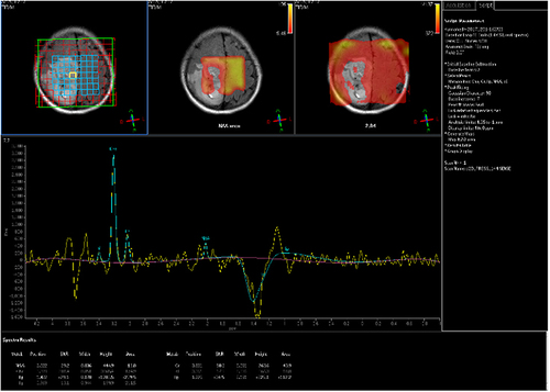 Figure 6 Female (25 years old) with headache and left lower limb weakness for two months. Magnetic resonance spectroscopy showing the internal choline peak of the tumor was significantly increased, creatinine peak was decreased, and the N-acetylaspartate peak was obviously decreased.