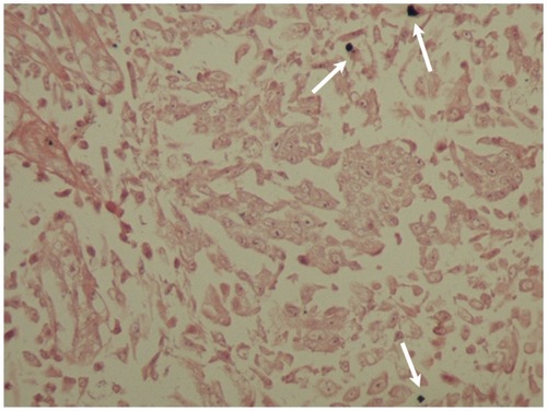 Figure 7 In situ hybridization of the squamous papilloma with mild dysplasia of patient 2. The nuclei of some epithelial cells are positive (arrows) for HPV DNA with broad spectrum probes (×400).