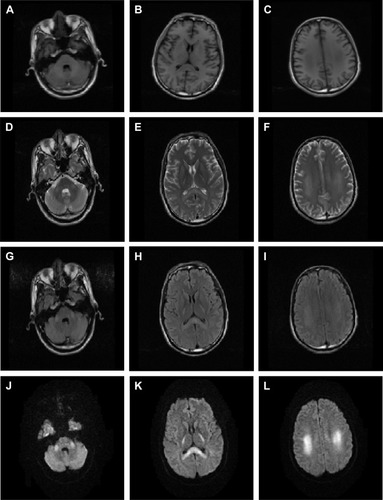 Figure 1 Brain MRI results: bilateral posterior limb of internal capsule, splenium of corporis callosum, and bilateral centrum semiovale that formed symmetrical patch distribution.