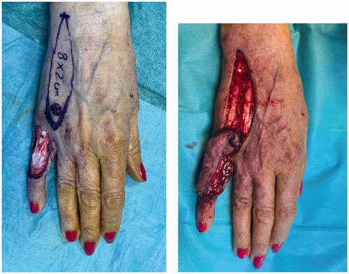 Figure 3. Intra-operative views after surgical excision of the tumor with preservation of the extensor apparatus (A) and after raising the flap (B).