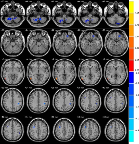 Figure 1 Clusters showing statistically significant different ALFF values in patients with PI compared with the controls (P<0.01, corrected). Numbers indicate z slice and are displayed in MNI coordinates.