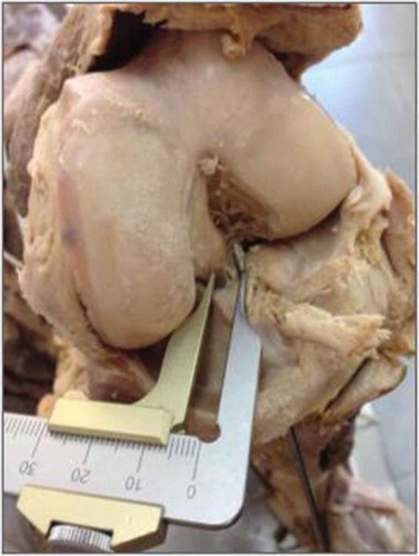 Figure 5. Distance from the guidewire placed in the tibial “footprint” to the PCL.Source: Anatomy Laboratory–UNIRIO, 2014–2015.