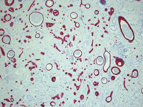 Figure 6 Epithelial cords lined by one or two layers of polygonal epithelial cells with comma-like tails, stained with cytokeratin marker AE1/AE3, ×100.