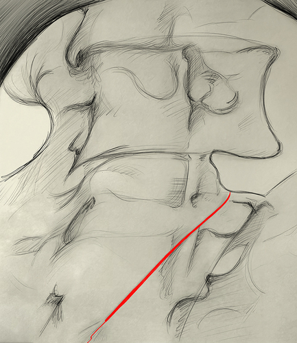 Figure 4 Oblique view showing the cannula (red) passing across the sulcus for the medial branch.