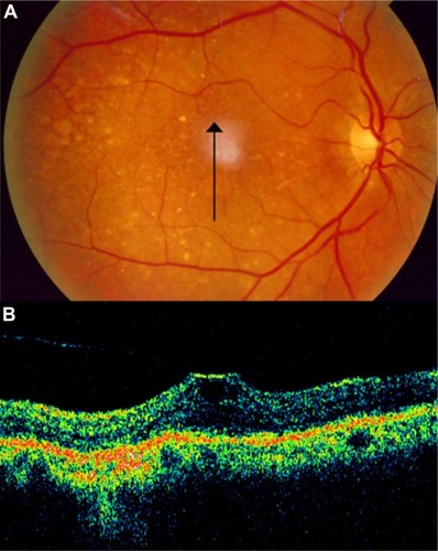 Figure 20 Vitreomacular traction syndrome and geographic atrophy.