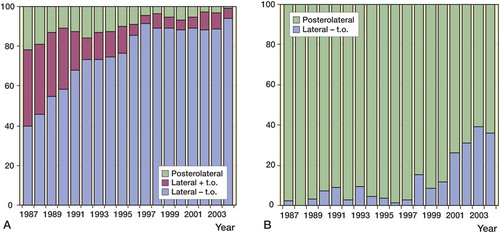 Figure 2. Distribution of surgical approaches used for Charnley and Exeter THA in 1987–2004.