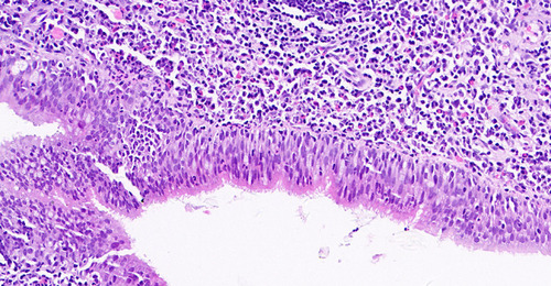 Figure 3 Biopsy revealed chronic inflammation of bronchial mucosa with lymphoid follicular hyperplasia, but no definite tumor cells (400X).