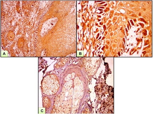 Figure 1 A case of SCC. (A) Moderate-to-strong nucleocytoplasmic expression of ATG7 both in tumor and the surrounding stoma. (B) High power view of previous case. (C) Mild-to-moderate nucleocytoplasmic immunohistochemical expression of ATG7 in sebaceous gland (ATG7 IHC ×200 for A and C and ×400 for B).