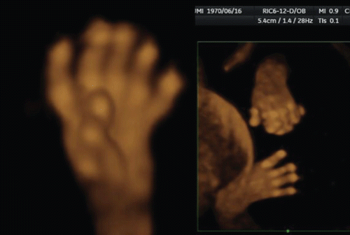 Figure 45.  Polydactyly and syndactyly at 14 weeks of gestation 3D reconstructed ultrasound images clearly depicted bilateral polydactyly (left) and left poly-/syndactyly (right). Both cases were associated with holoprosencephaly.