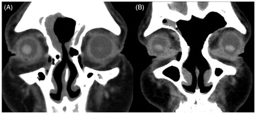 Figure 3. Postoperative CT scans of case 1 (A) and case 2 (B). The outflow tracts were maintained in both cases.